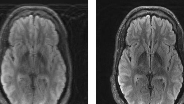 MIT researchers combine deep learning and physics to fix motion-corrupted MRI scans