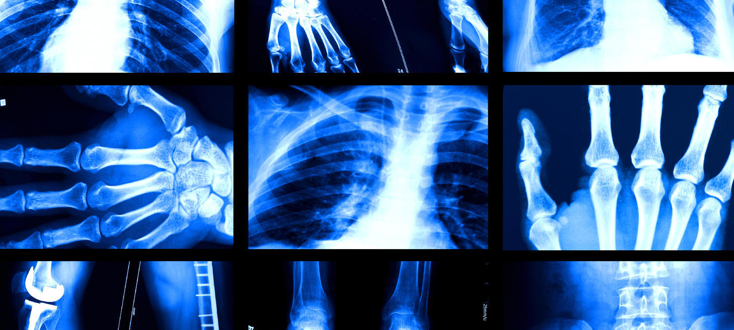 Study reveals why AI models that analyze medical images can be biased