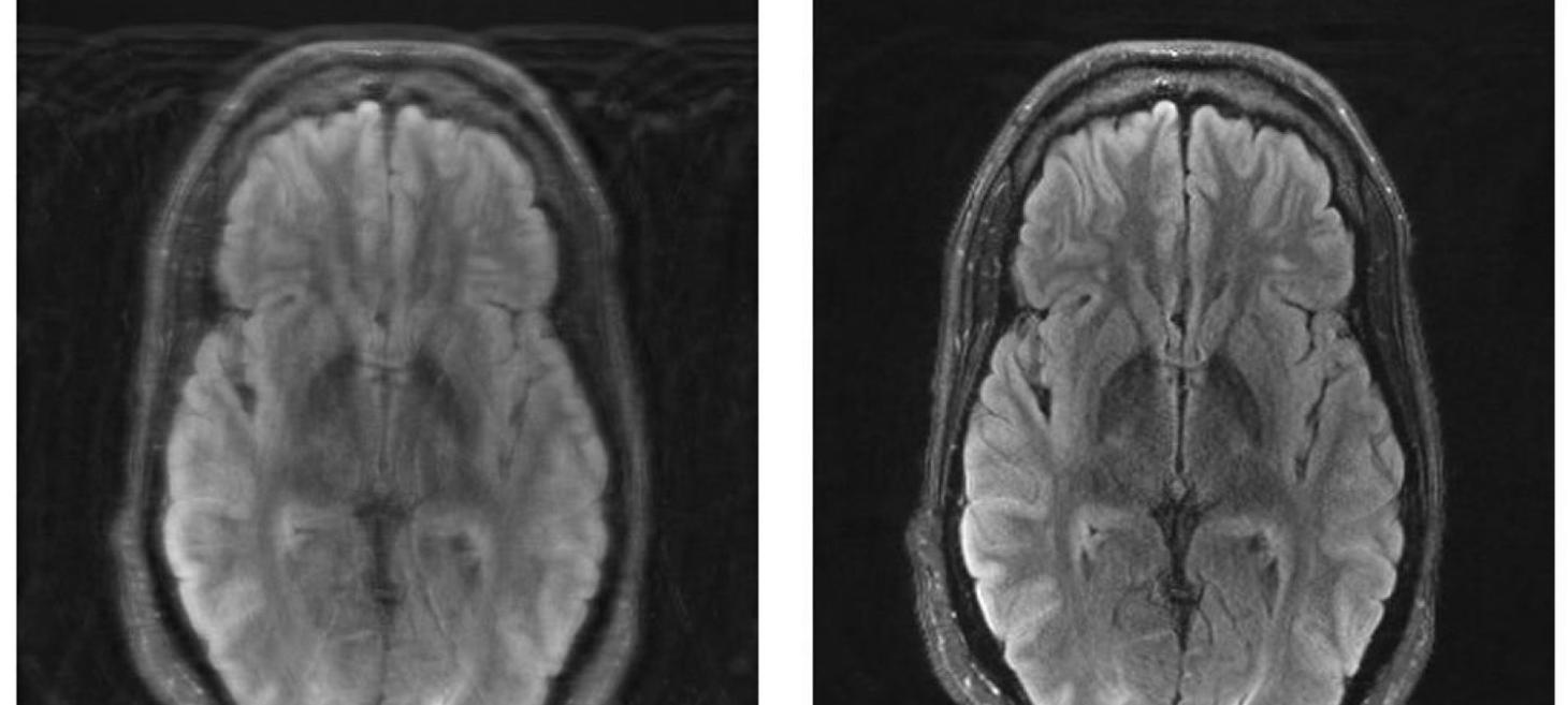 MIT researchers combine deep learning and physics to fix motion-corrupted MRI scans