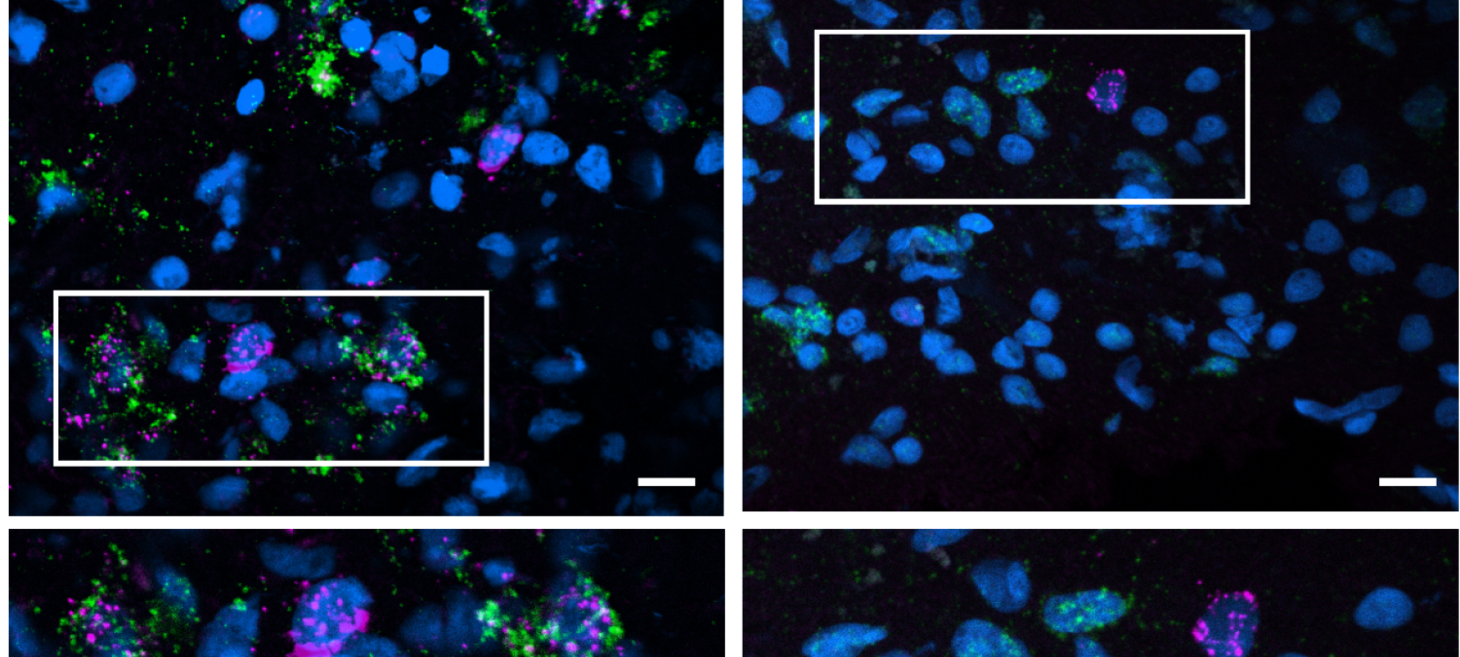 Study across multiple brain regions discerns Alzheimer’s vulnerability and resilience factors