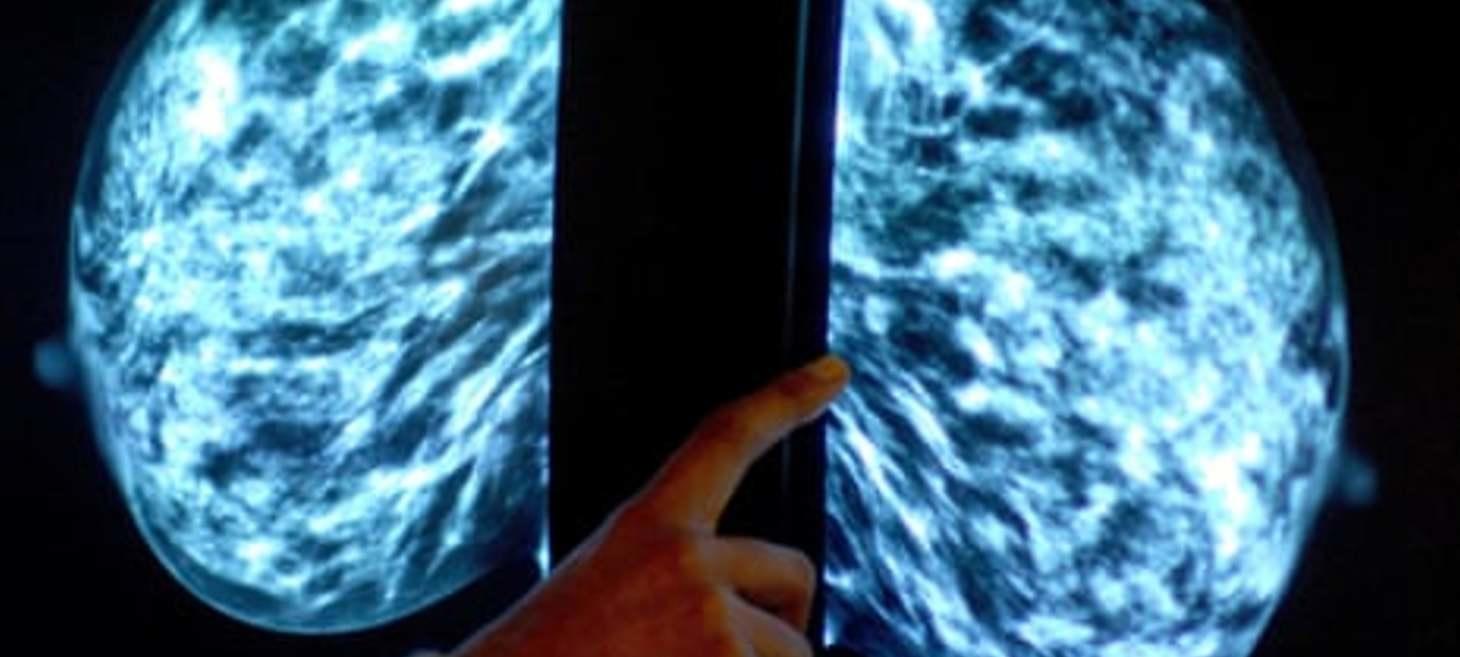 NHS to launch world’s biggest trial of AI breast cancer diagnosis